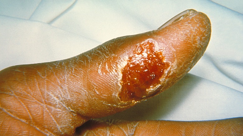 Skin ulcer caused by tularemia 