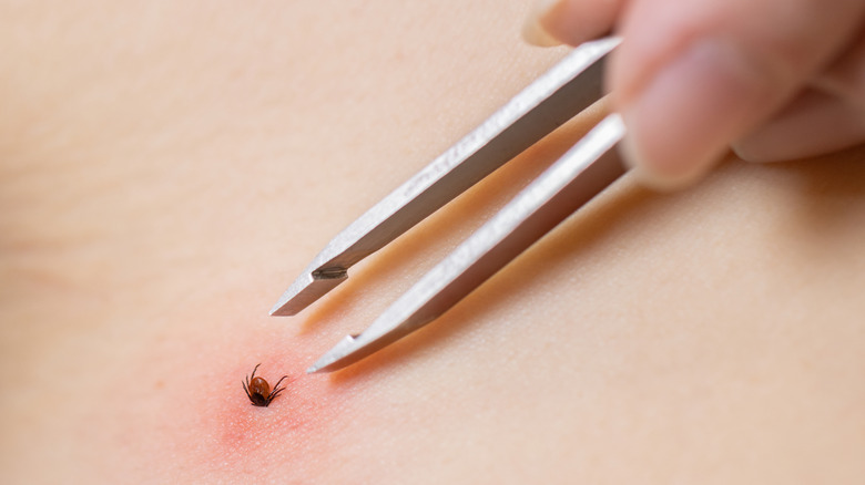 Removing a tick with tweezers