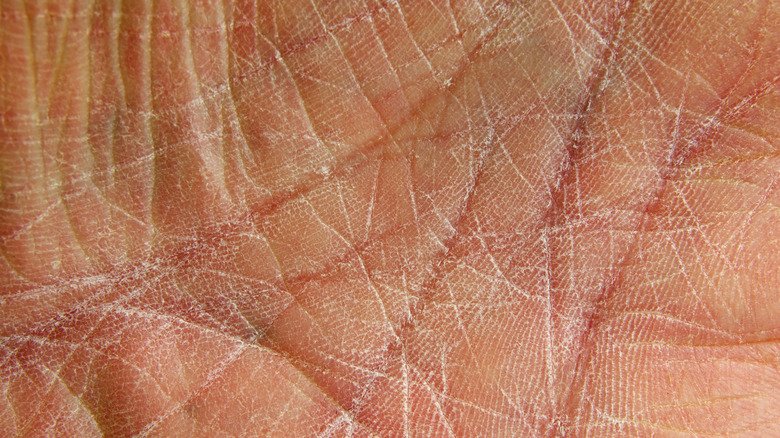Close-up of dry skin