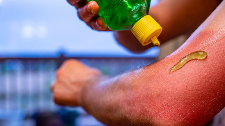 Person squeezing aloe on sunburned arm