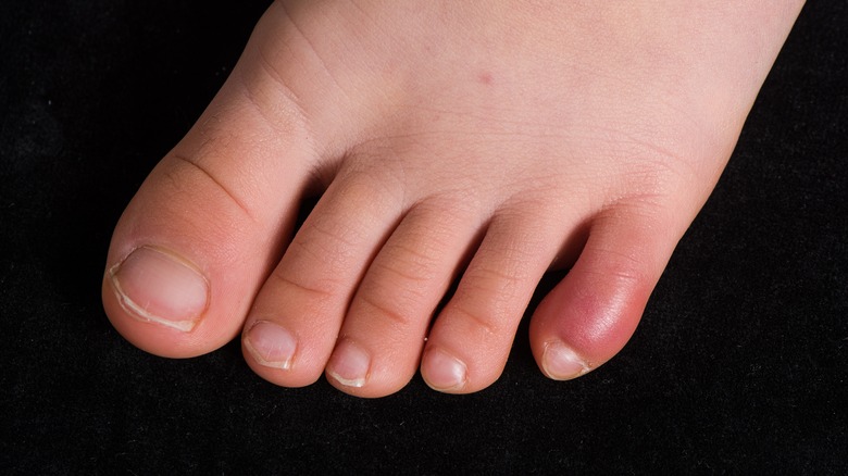 Chilblain toes child foot