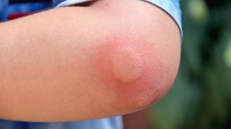 Inflamed insect bite on elbow