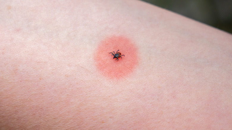 Tick on reddened circle of skin