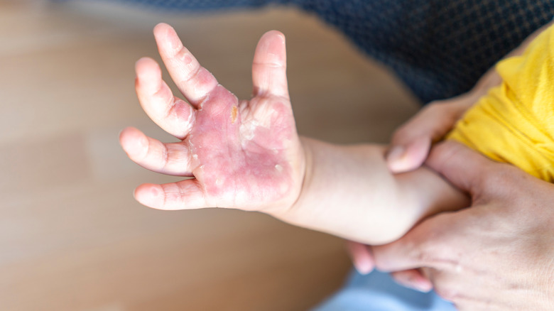 Burned hand of small child